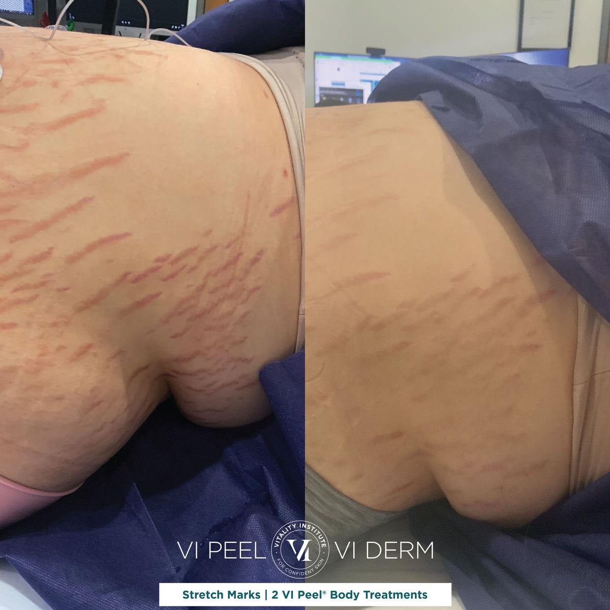VI Body Peel Large Area - 3 Sessions
