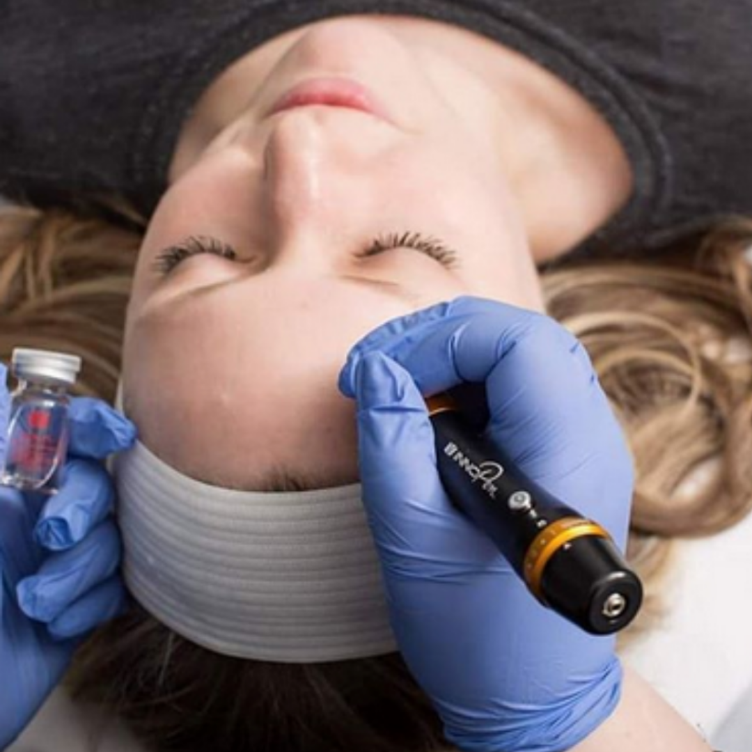 Microneedling - 1 Session $199
