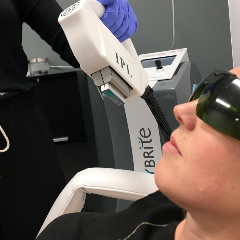 Laser Hair Removal - Microzone Area