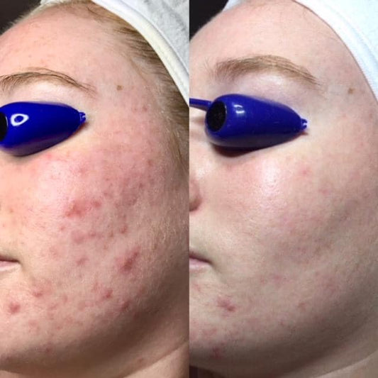 The Benefits of IPL Therapy