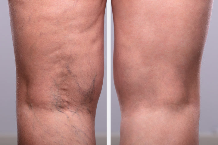 Spider Vein Treatments: Sclerotherapy versus Intense Pulse Light (IPL)