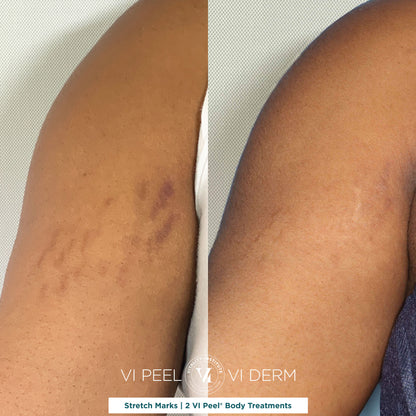 VI Body Peel Small Area - 3 Sessions