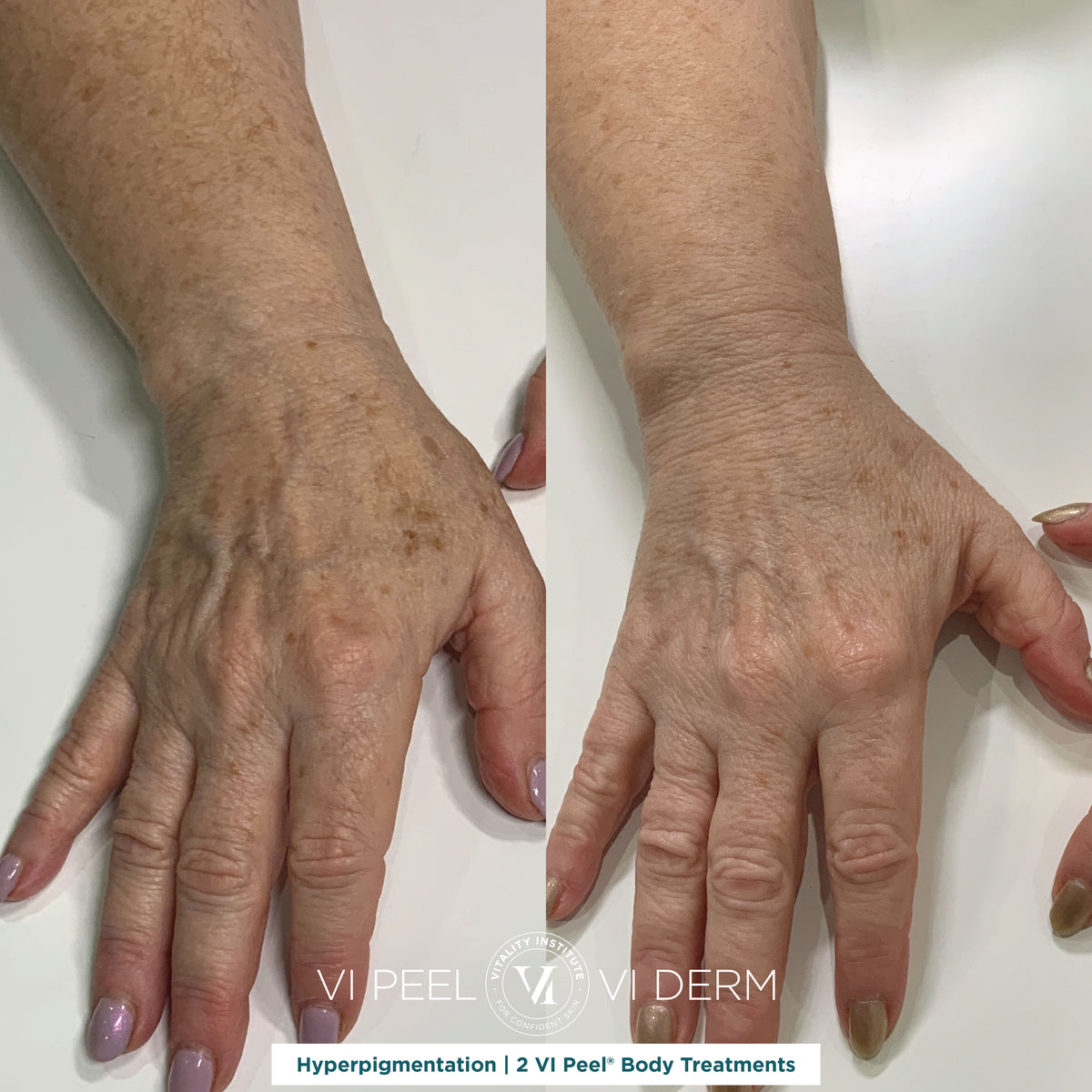 VI Body Peel Small Area - 3 Sessions