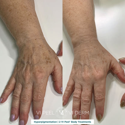 VI Body Peel Small Area - 3 Sessions