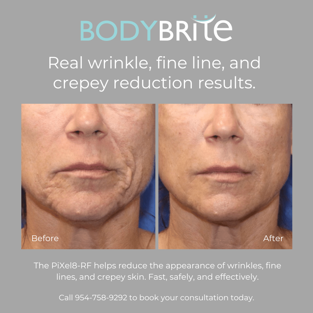 Pixel8 RF Microneeling Packages for Face and Neck  -  Package of 3