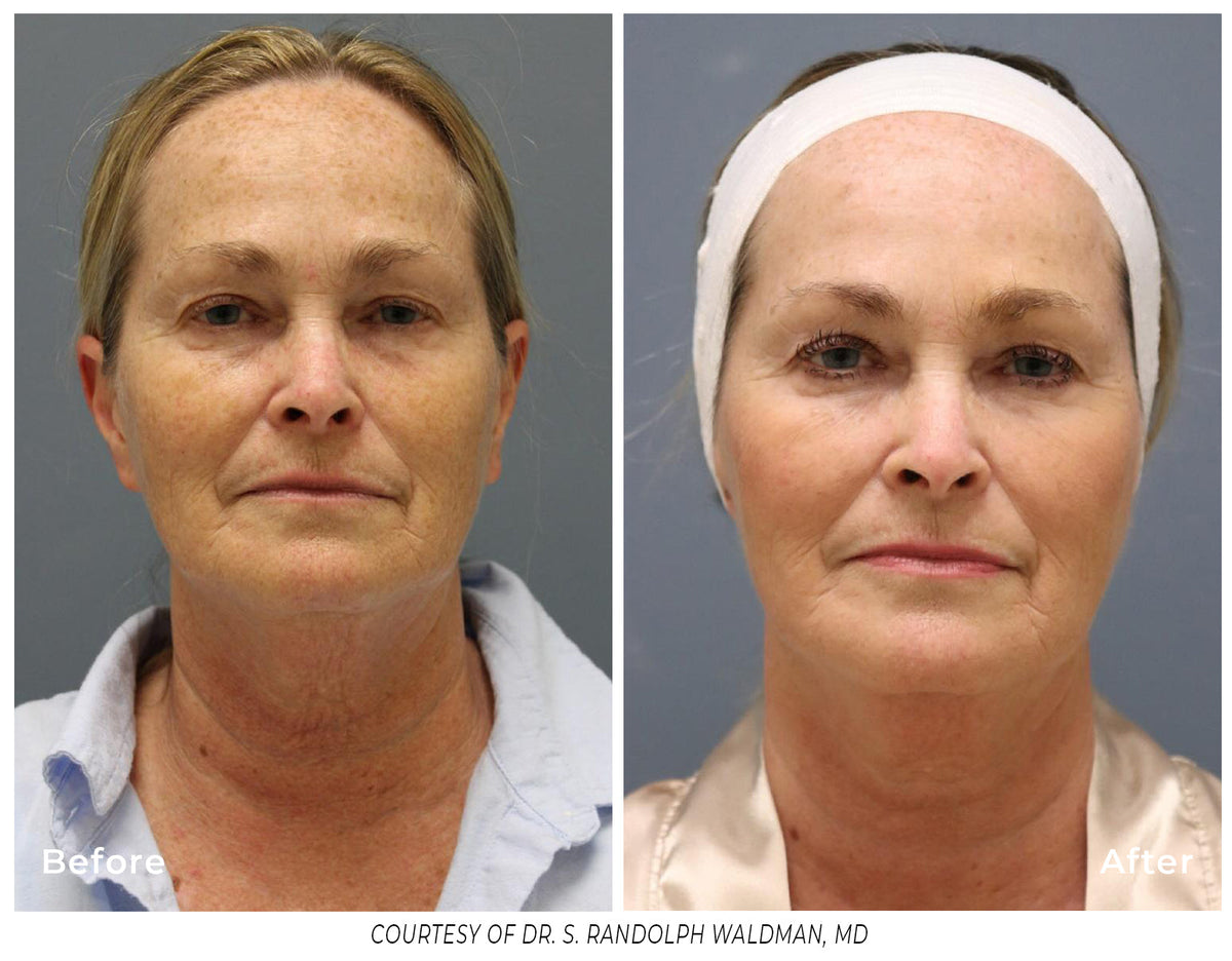 Pixel8 RF Microneeling Packages for Face and Neck  -  Package of 3