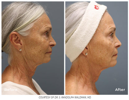 Pixel8 RF Microneeling Packages for Face Only  - Buy 2 Get 1 Free