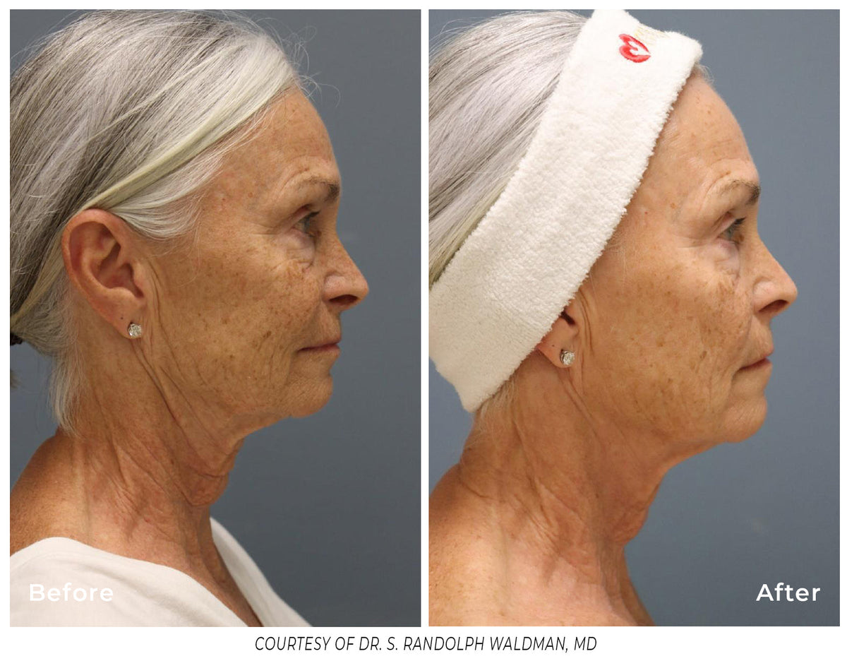 Pixel8 RF Microneeling Packages for Face and Neck  -  Package of 3
