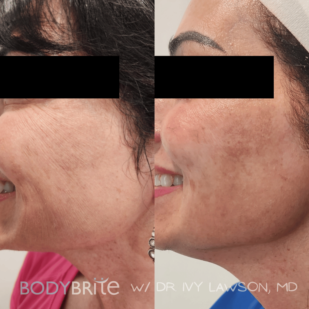 Day 4 Skintastic Savings -  Buy 1 RF Microneedling Treatment for Face and Receive 50% OFF A Second Treatment