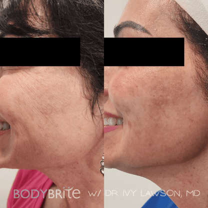 Day 4 Skintastic Savings -  Buy 1 RF Microneedling Treatment for Face and Receive 50% OFF A Second Treatment