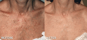 IPL Skin Rejuvenation Body - 6 Sessions for Small Area