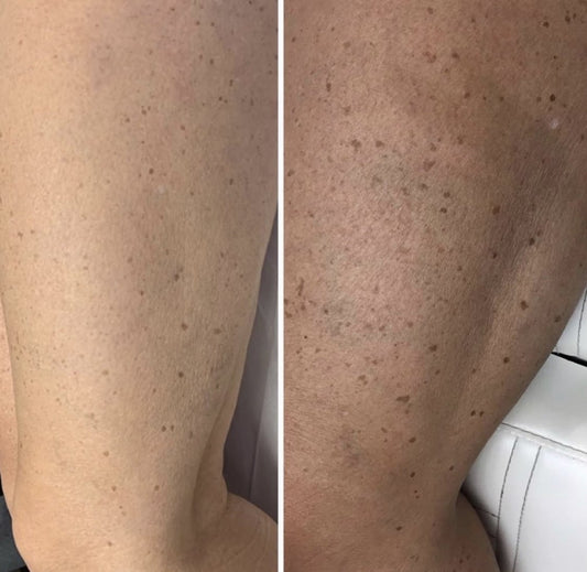 IPL Skin Rejuvenation - 3 or 6 Sessions for Legs