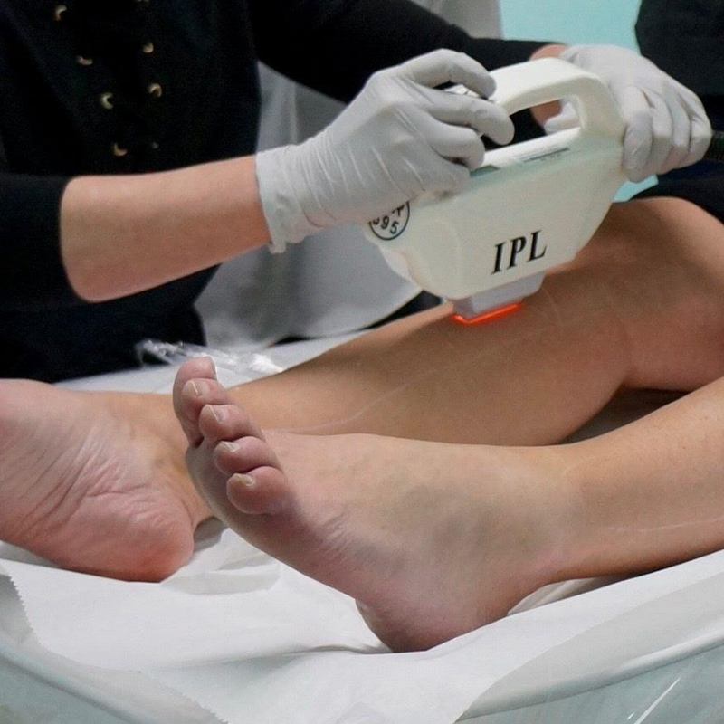 Depilación IPL - 6 sesiones para 1 zona mediana