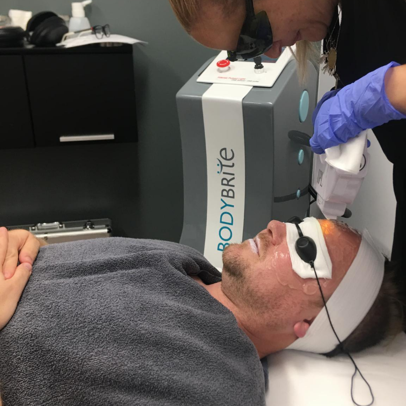 3 IPL Photofacials for Pigmentation